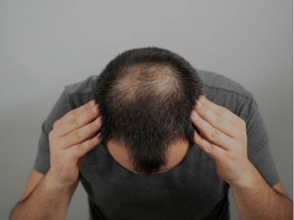 Hair-loss-men